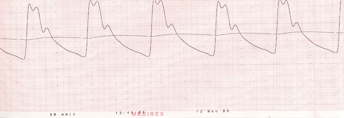 A katéter átmosása után thermoprinter szalagon folyamatosan rögzítettük az intrabrachiális nyomásgörbét, majd elindítottuk az arteriográf mérést, így annak egész működése alatt identikus és szimultán