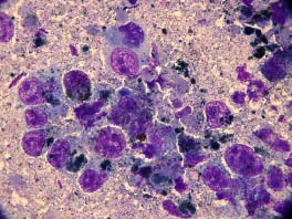 Mastoytoma Mastoytoma Melanoma Melanoma A kemoterápia alkalmazása 1) Elsődlegesen választandó haemopoieticus eredetű (myelo-, lympho- proliferativ) daganatok