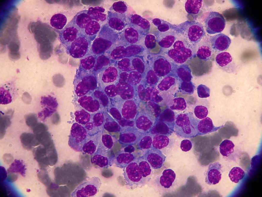 Fibrosarcoma