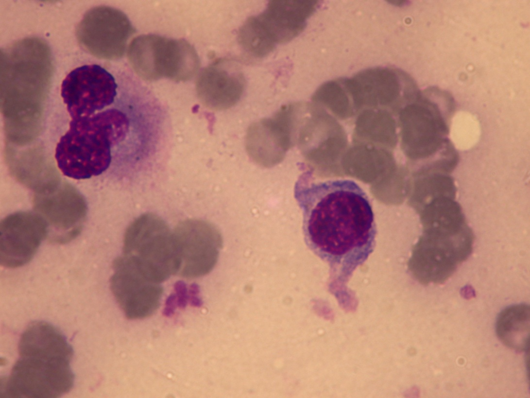 sarcoma   3 3