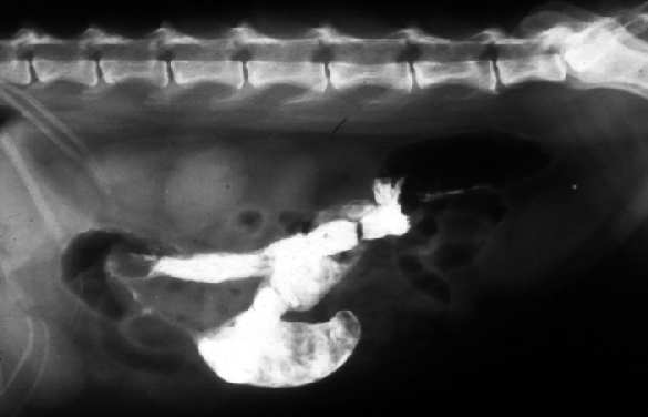 Liposarcoma Fibrosarcoma