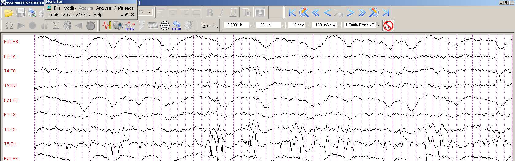 GYERMEKKORI OKCIPITÁLIS EPILEPSZIA: PANAYIOTOPOULOS / GASTAUT ROHAMSZEMIOLÓGIA: :