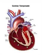 Pericardiális TAMPONÁD Életveszélyes állapot, gyors