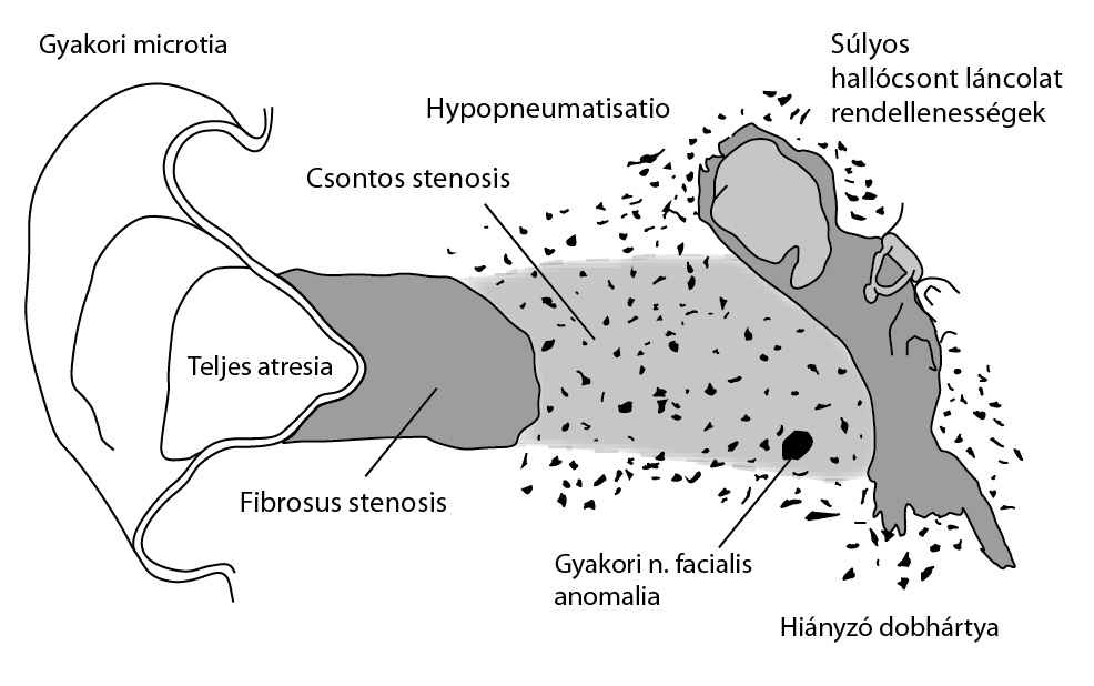 Amikor mindez a 21. gesztációs hét környékén történik, akkor az epithelialis lefűződés nem lesz teljes. Részleges vagy teljes atresia alakulhat ki (3. ábra) [17]. 3.