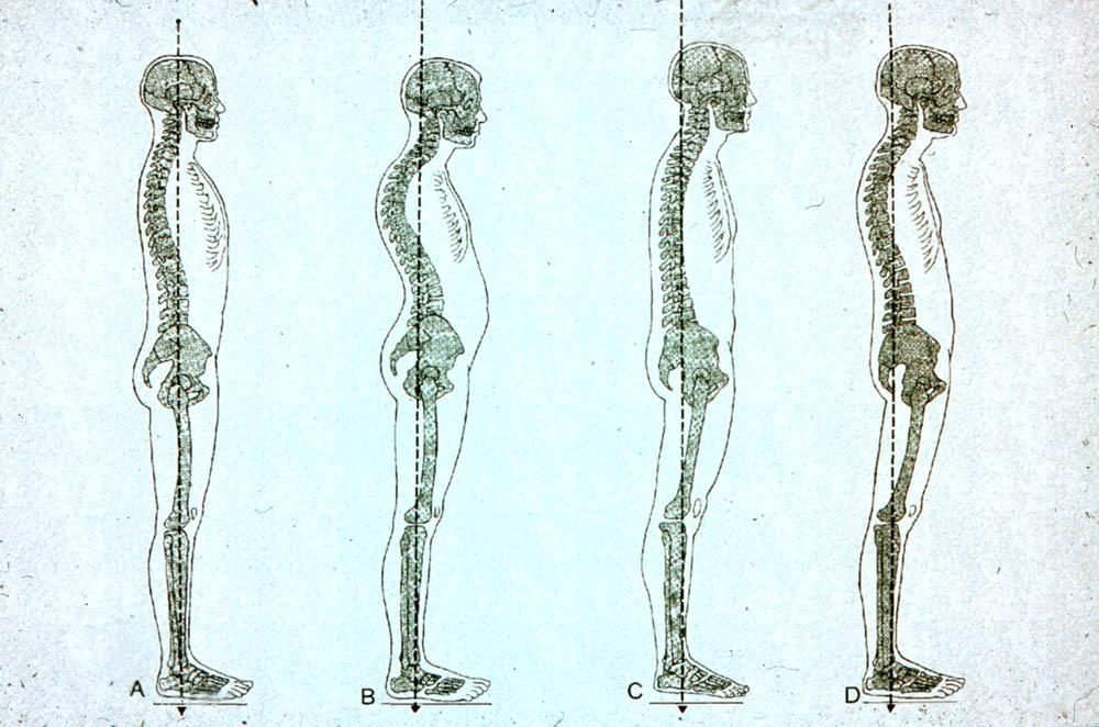 3. ábra: A: A helyes testtartás B, C, D: A helytelen testtartások különböző formái Helytelen tartás esetén a medencénket nem a megfelelő helyzetben tartjuk (nő vagy csökken a medence dőlésszöge),