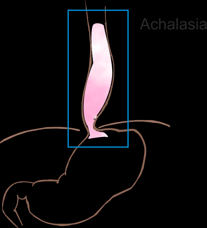 12. ábra: Achalasia esetén a cardia izomzata nem relaxál, így a nyelőcső ürülési zavara mellett folyamatosan emelkedett nyomás, permanens nyálkahártya irritáció és mellkasi fájdalom lép fel.