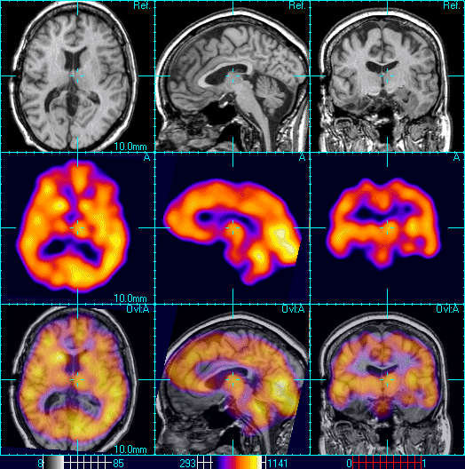 Károsodás mértékének meghatározása Rutinlabor CT/MR/SPECT Fehérállományi károsodás (MR) Speciális labor (B12, immunológiai) Szérum: antikolinerg szerek, benzodiazepinek, barbiturátok EEG