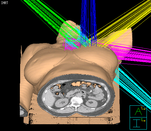 APERT eredmények 3D-KRT tanulmányok (követési idő 4 év) Intézet Időszak APERT Betegszám Medián LR% Éves LR% technika követés (év) 3D-KRT szériák New York University 2000-05 3D-KRT 98 5,3 1 0,19 W.
