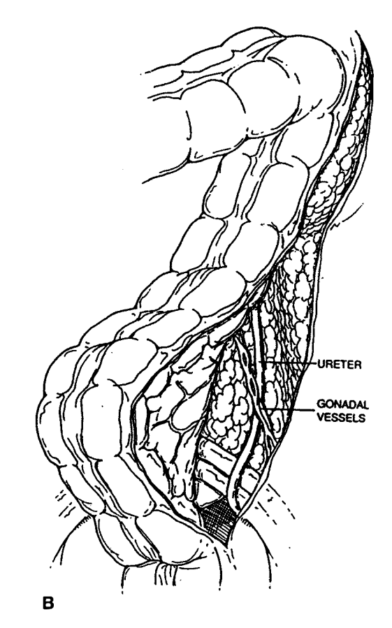 Resectio anterior Bal