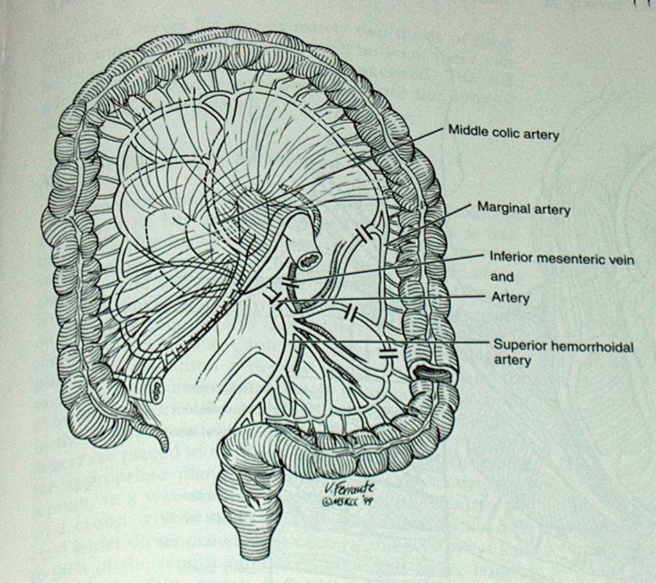 Resectio anterior