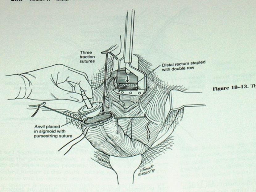 Anastomosis: double