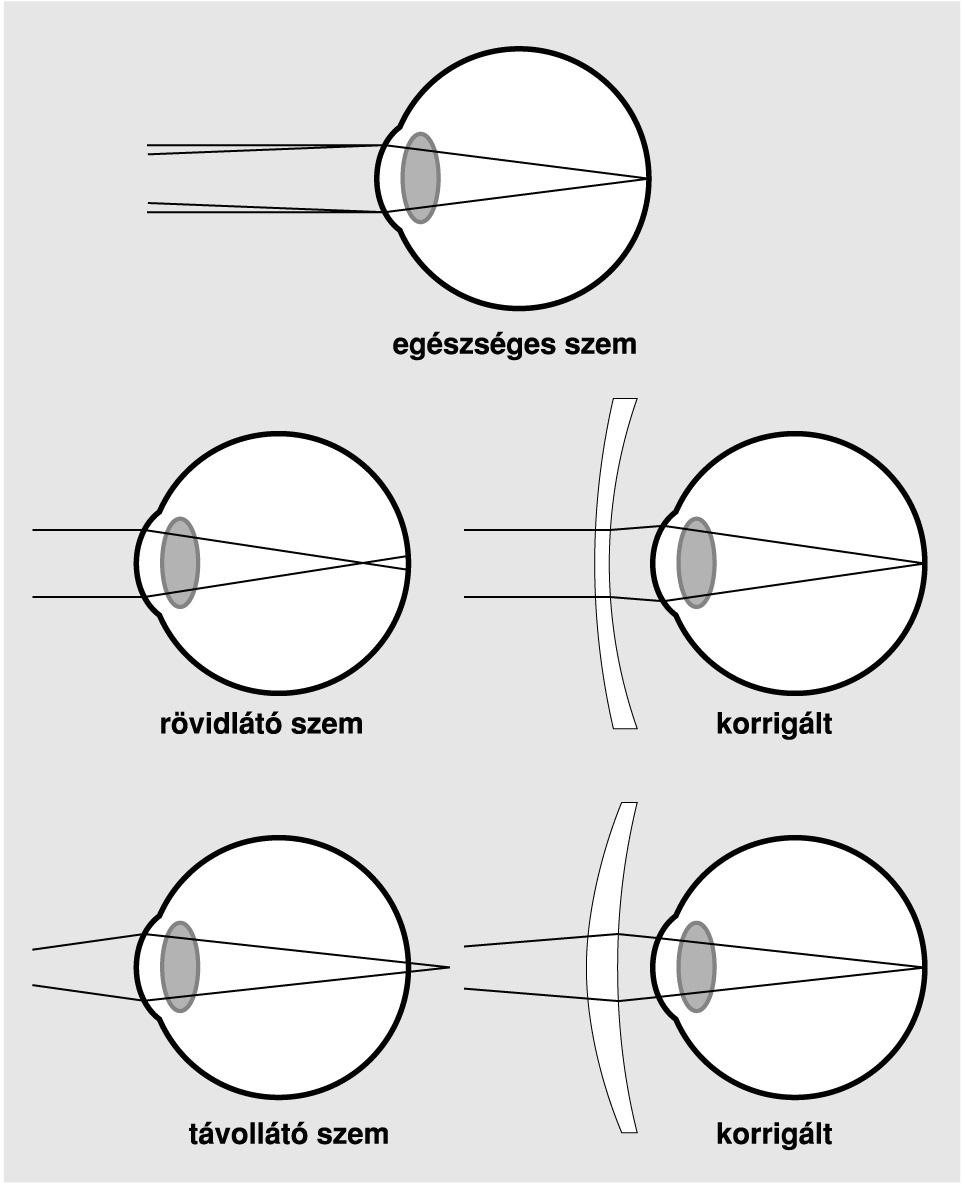 AZ EMBERI SZEM GEOMETRIAI OPTIKÁJA Myopia