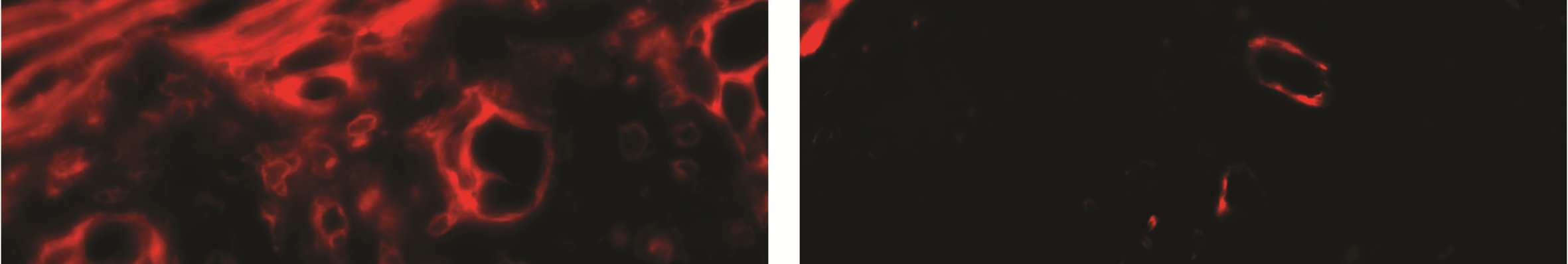 34. ábra A TNFR-I/II immunfluoreszcens megjelenése otosclerosisban. A1: Az otosclerosis aktív stádiuma (HE).