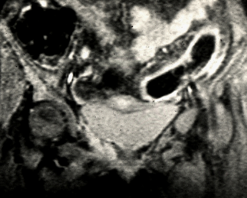 CT IBD-ben M.