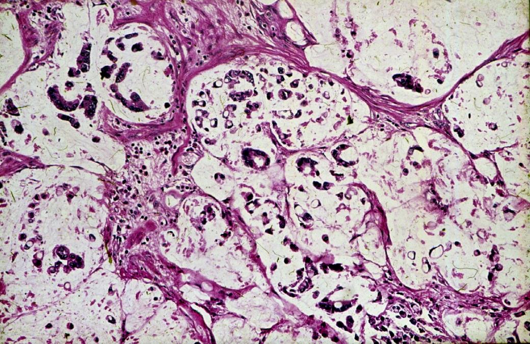 Nyáktermelő adenocarcinomák -carcinoma muciparum