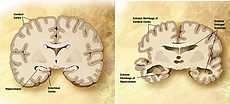 Általános jellemzők Az Alzheimer kór a szenilis demenciák leggyakrabban előforduló formája, melyet Alois Alzheimer 1906-ban írt le (Berchtold és Cotman, 1998).