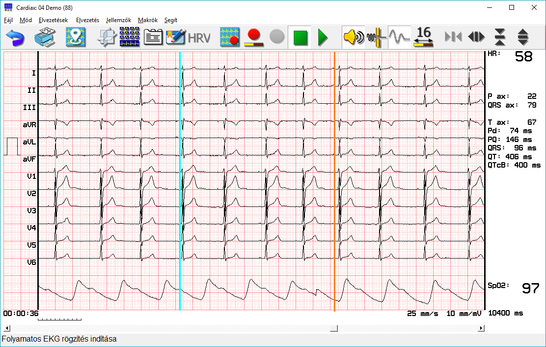 6. Eltárolt EKG felvételek 6.1 EKG-vonalzó (manuális mérés) A görbe a nullvonal-ingadozás korrigálása után jelenik meg a képernyőn.