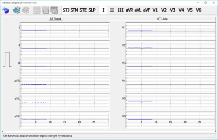 Szintén az EKG vonalzóból (EKG megjelenítő), az ergometria felvételekhez hasonlóan, itt is lehetőség van az EKG jelben található