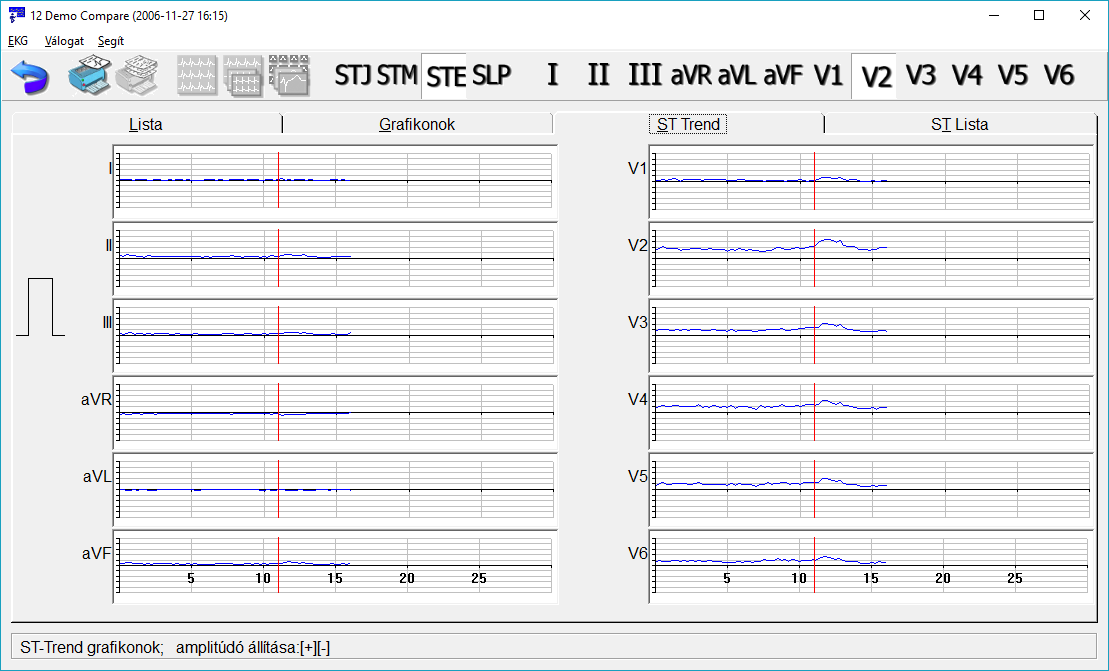 11.3 ST kiértékelés ST-Trend A képernyőn a 12 standard elvezetés ST diagramjai láthatók az idő függvényében.