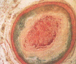 Egyéb etiológia Intracraniális stenosis Ischaemiás stroke 10-29%