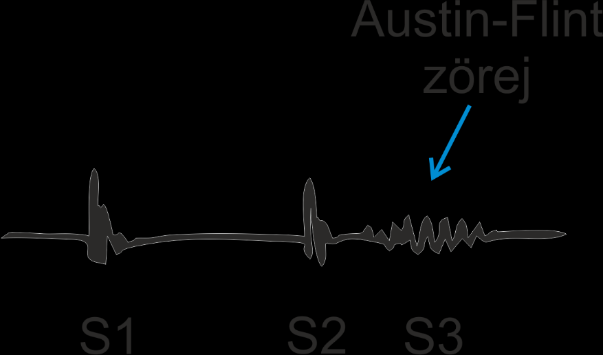 7. ábra. Az aorta billentyű elégtelensége miatt kialakuló decrescendo típusú diasztolés zörej, mely 2R2-ben hallható.