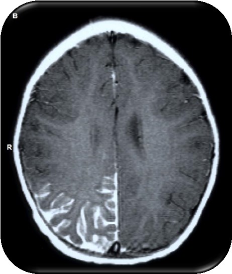 27. ábra Fokális leptomeningeális angiomatózis MR felvétele. Centro-parietális (A) és occipitális (B) lézió a kontrasztanyagos T1 felvételeken.