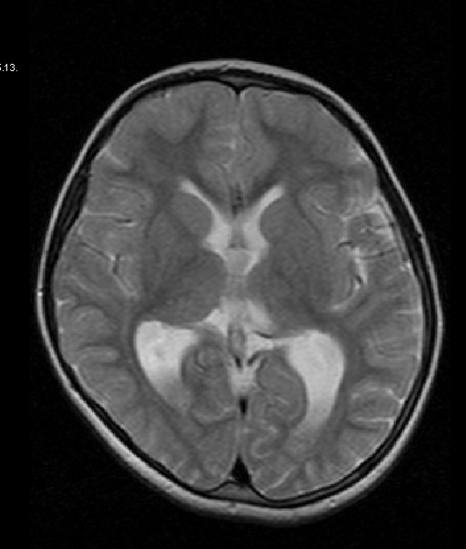 Focalis corticalis dysgenesis két ESES betegnél 29. ábra Jobb féltekei polymicrogyria (A), illetve jobb perisylvian polymicrogyria (B) az ESES szindróma hátterében.