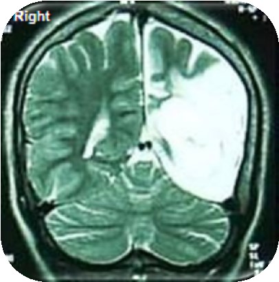 19. ábra Az MR felvételen egy 16 éves leány intrauterin stroke következtében kialakult bal oldali