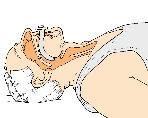Basic/Advanced Life Support Átjárható