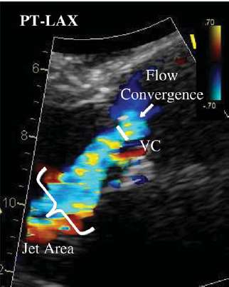 Vena contracta A regurgitációs jet legkeskenyebb része a billentyű LVOT felé eső oldalán PLAX Kis color ablak, zoom