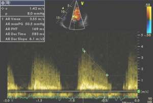 Nyomásfelezési idő (PHT) CW doppler (csúcsi 5 üreg) A vérnyomás ill.