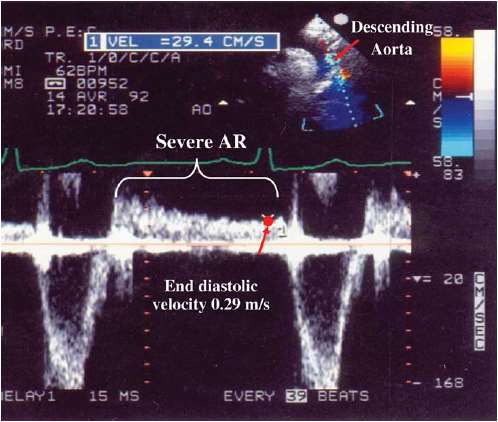 Aorta descendens diastolés reverz PD, Suprasternális nézet Holodiastolés reverz flow: súlyos AR