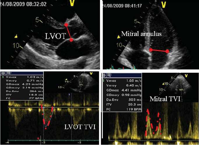 Doppler volumetriás módszer AR esetén az LVOT SV= szisztémás SV+ regurgitációs volumen RV= LVOT