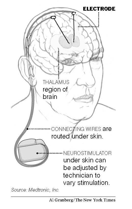 Neuromoduláció (ultima ratio): (anterior