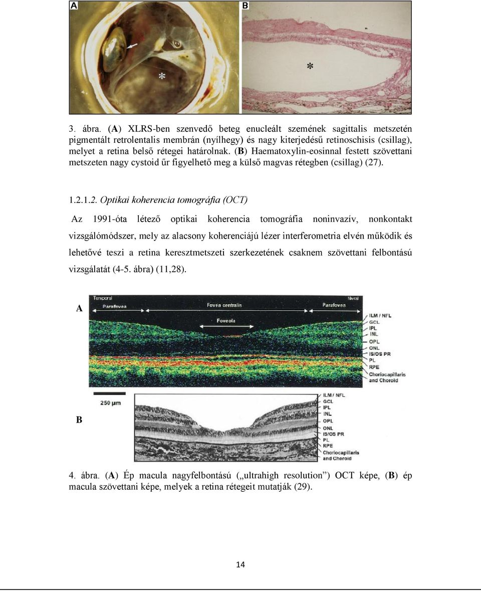 (B) Haematoxylin-eosinnal festett szövettani metszeten nagy cystoid űr figyelhető meg a külső magvas rétegben (csillag) (27