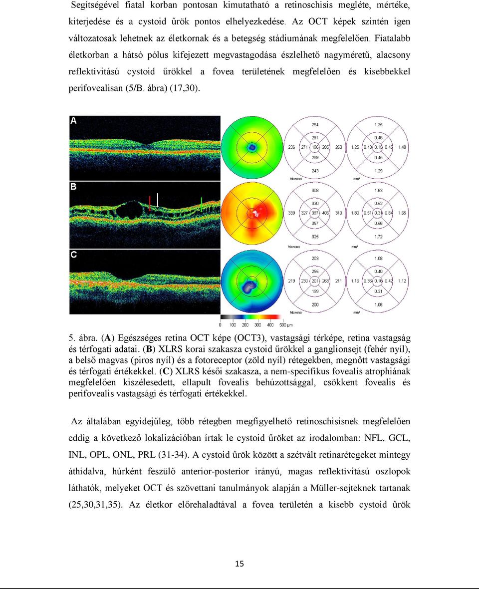 Fiatalabb életkorban a hátsó pólus kifejezett megvastagodása észlelhető nagyméretű, alacsony reflektivitású cystoid űrökkel a fovea területének megfelelően és kisebbekkel perifovealisan (5/B.