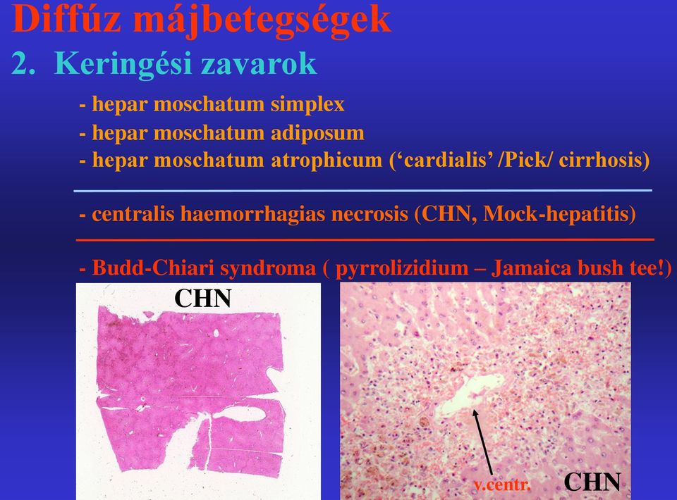 - hepar moschatum atrophicum ( cardialis /Pick/ cirrhosis) - centralis