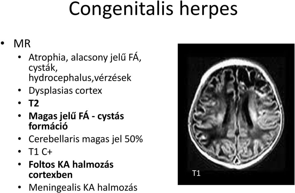 Magas jelű FÁ cystás formáció Cerebellaris magas jel