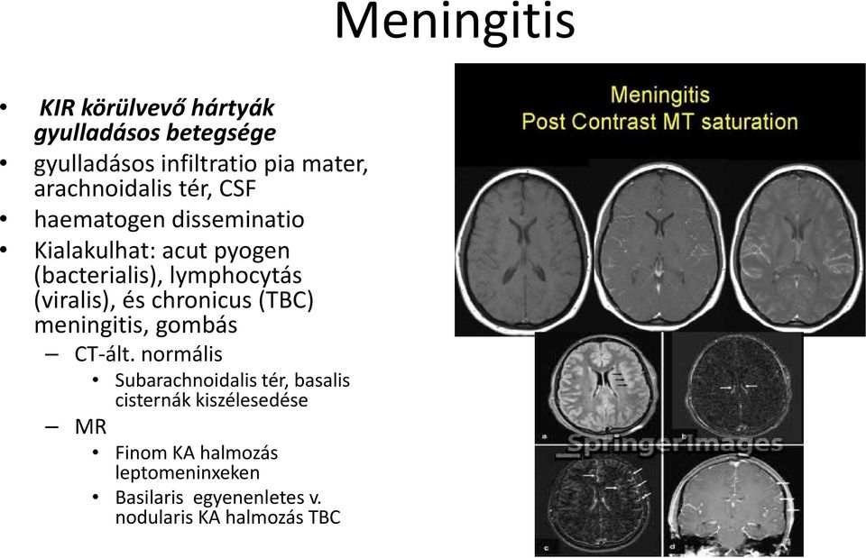 (viralis), és chronicus (TBC) meningitis, gombás CT ált.