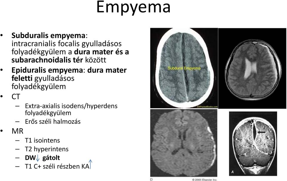 feletti gyulladásos folyadékgyülem CT MR Extra axialis isodens/hyperdens