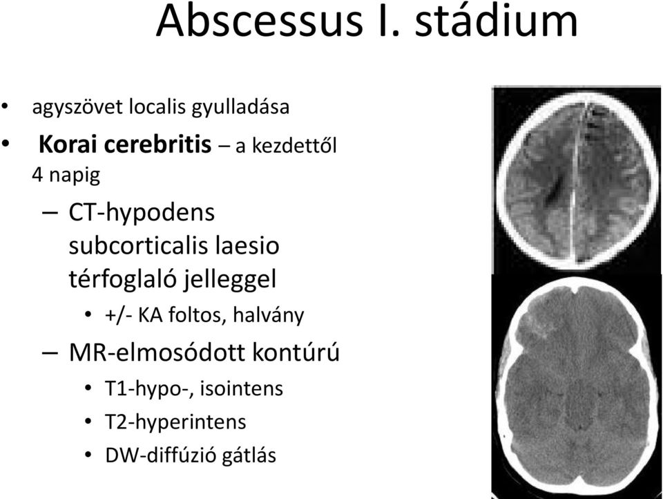 kezdettől 4 napig CT hypodens subcorticalis laesio