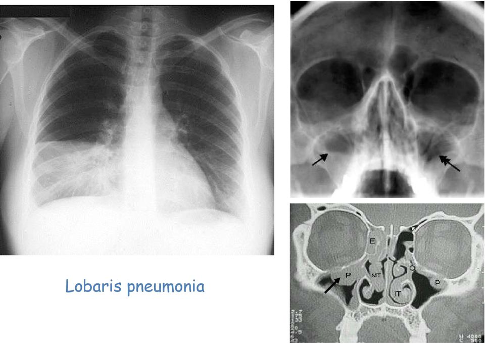 Sinusitis