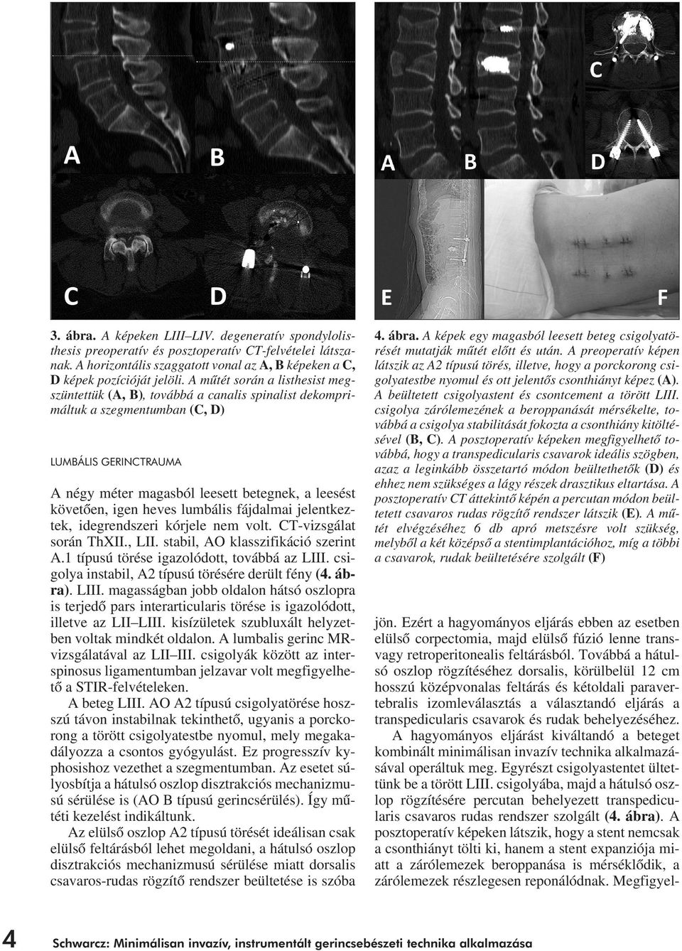 igen heves lumbális fájdalmai jelentkeztek, idegrendszeri kórjele nem volt. CT-vizsgálat során ThXII., LII. stabil, AO klasszifikáció szerint A.1 típusú törése igazolódott, továbbá az LIII.