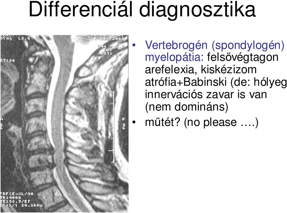 arefelexia, kiskézizom atrófia+babinski (de: