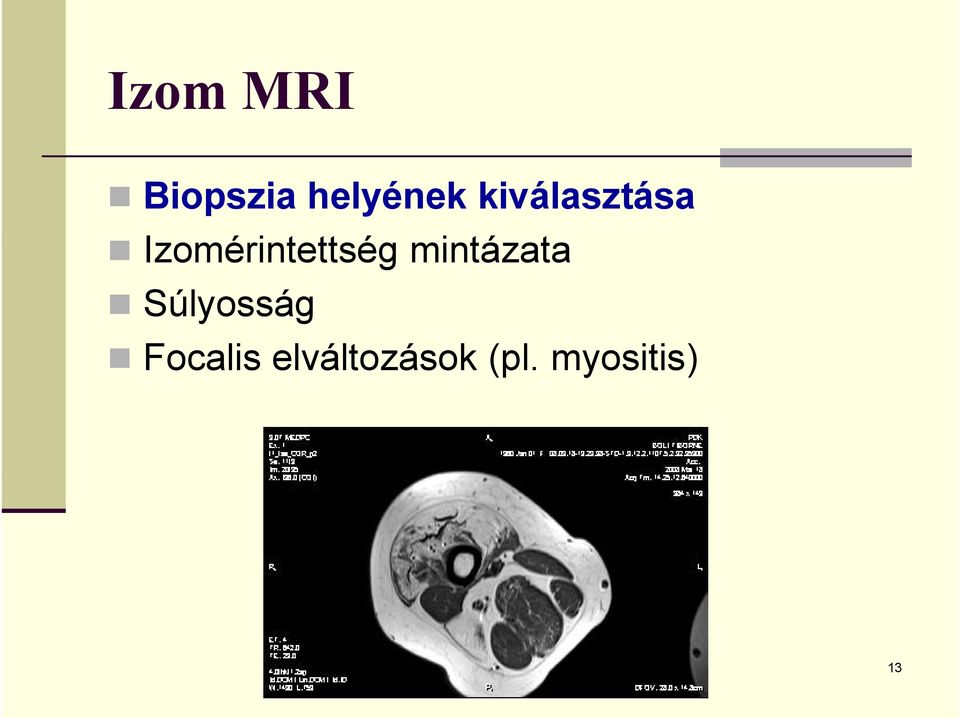 mintázata Súlyosság Focalis