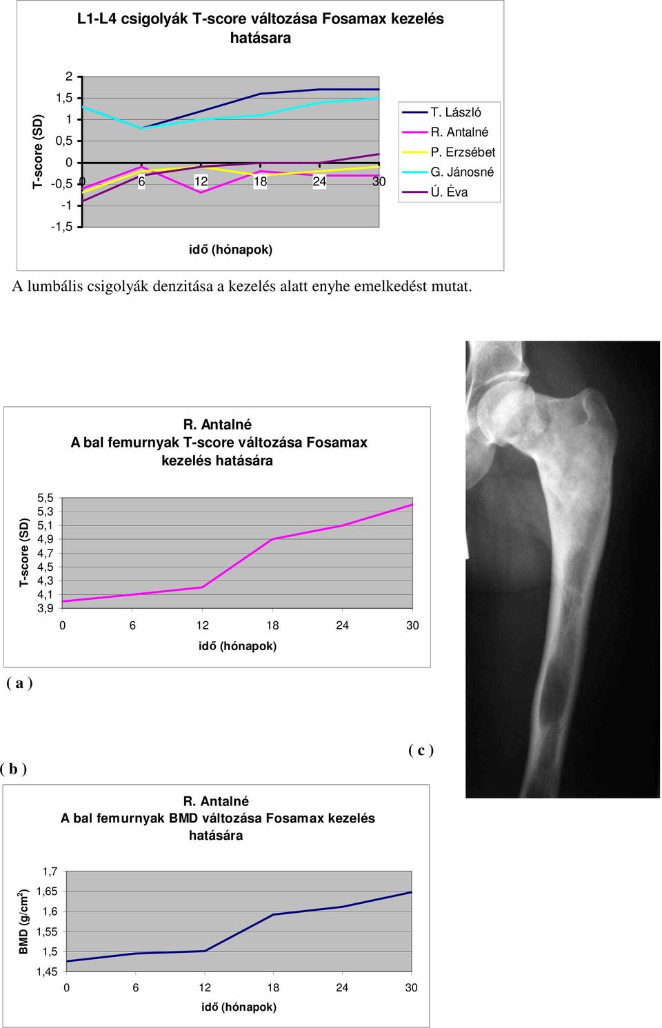 Antalné A bal femurnyak T-score változása Fosamax kezelés hatására T-score (SD) 5,5 5,3 5,1 4,9 4,7 4,5 4,3 4,1 3,9 6 12 18 24 3 idő