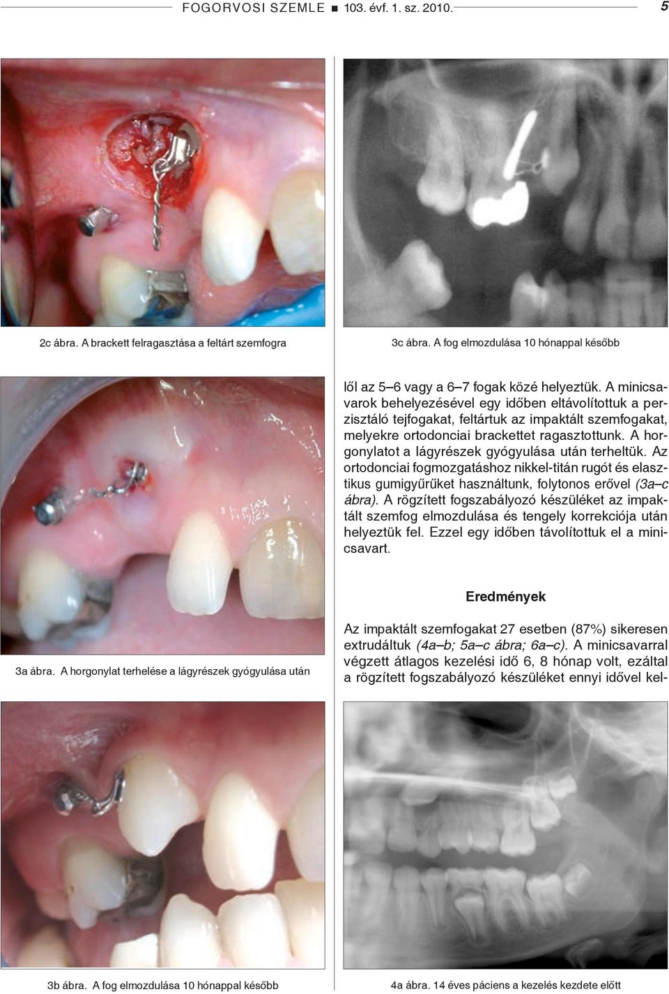 A horgonylatot a lágyrészek gyógyulása után terheltük. Az ortodonciai fogmozgatáshoz nikkel-titán rugót és elasztikus gumigyűrűket használtunk, folytonos erővel (3a c ábra).