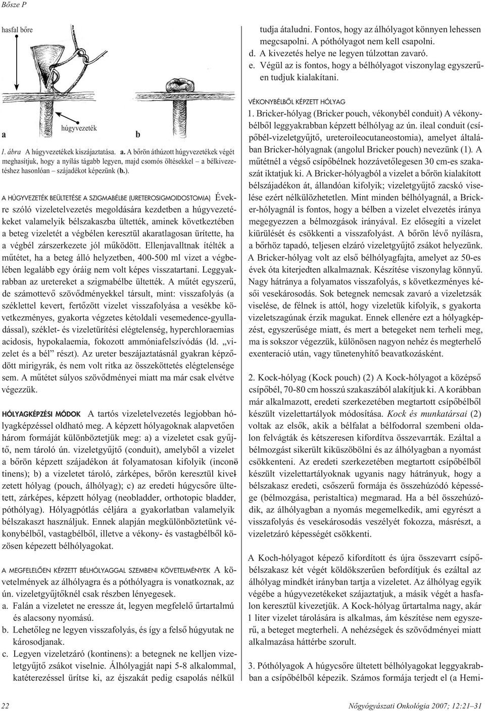 ). A HÚGYVEZETÉK BEÜLTETÉSE A SZIGMABÉLBE (URETEROSIGMOIDOSTOMIA) Évekre szóló vizeletelvezetés megoldására kezdetben a húgyvezetékeket valamelyik bélszakaszba ültették, aminek következtében a beteg