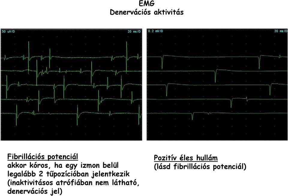 jelentkezik (inaktivitásos atrófiában nem látható,