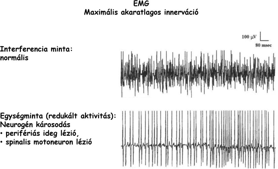 (redukált aktivitás): Neurogén károsodás